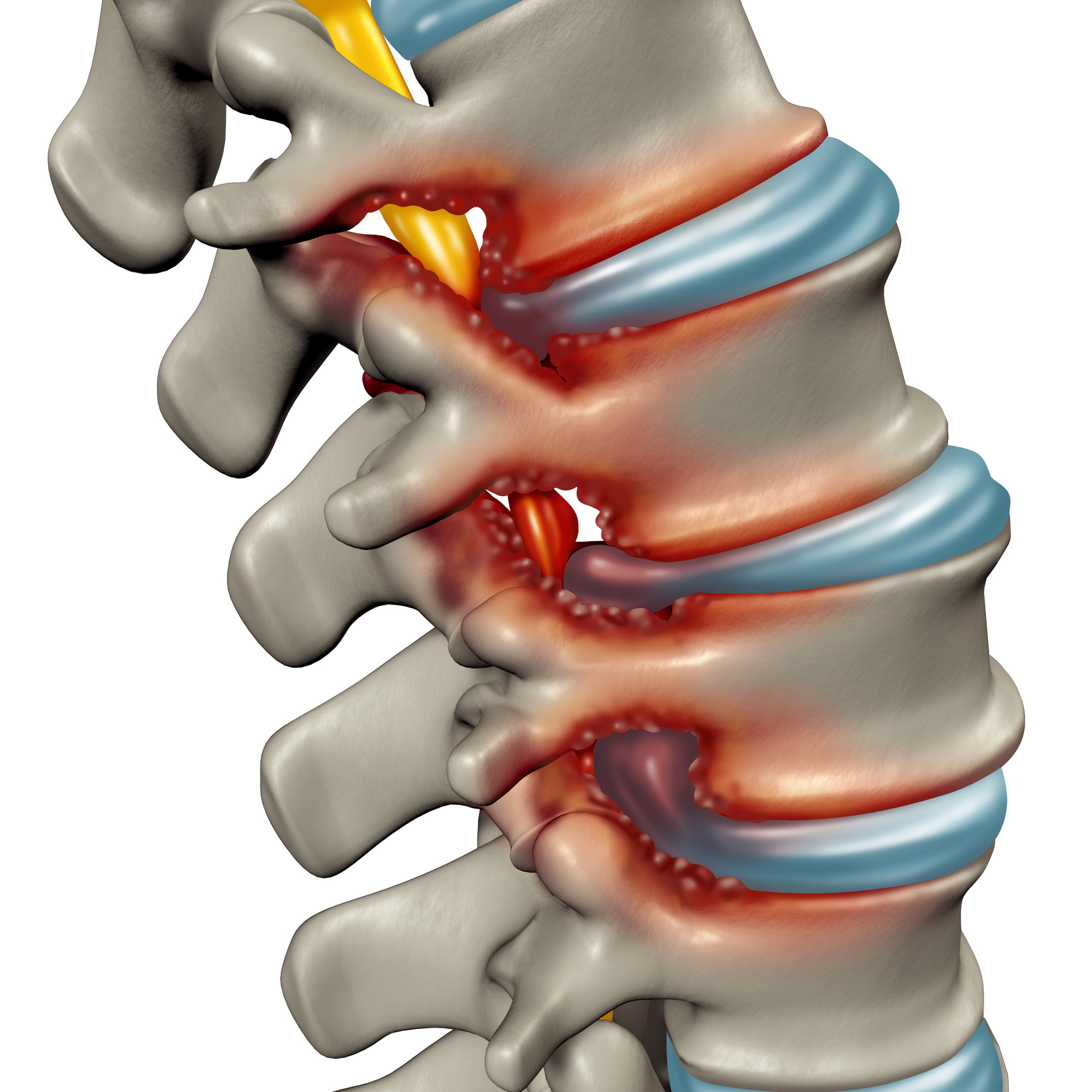 Spinal Stenosis - Washingtonian