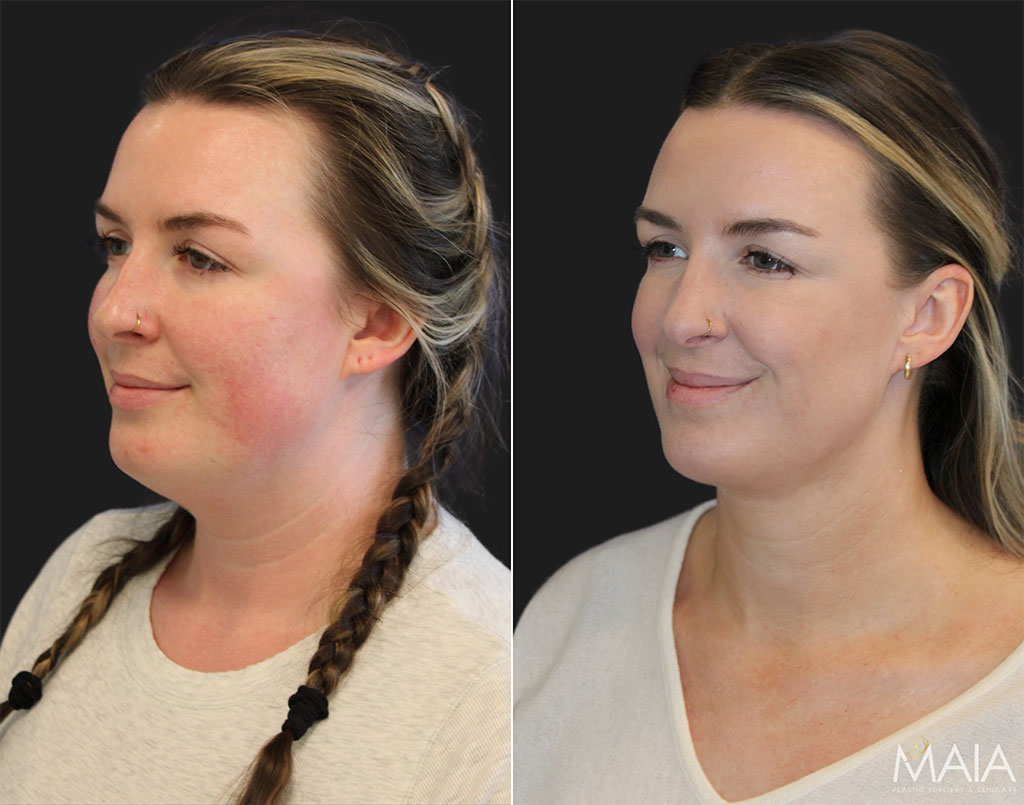 12016-31-year-old-patient-before-and-6-weeks-after-awake-neck-liposuction - Washingtonian