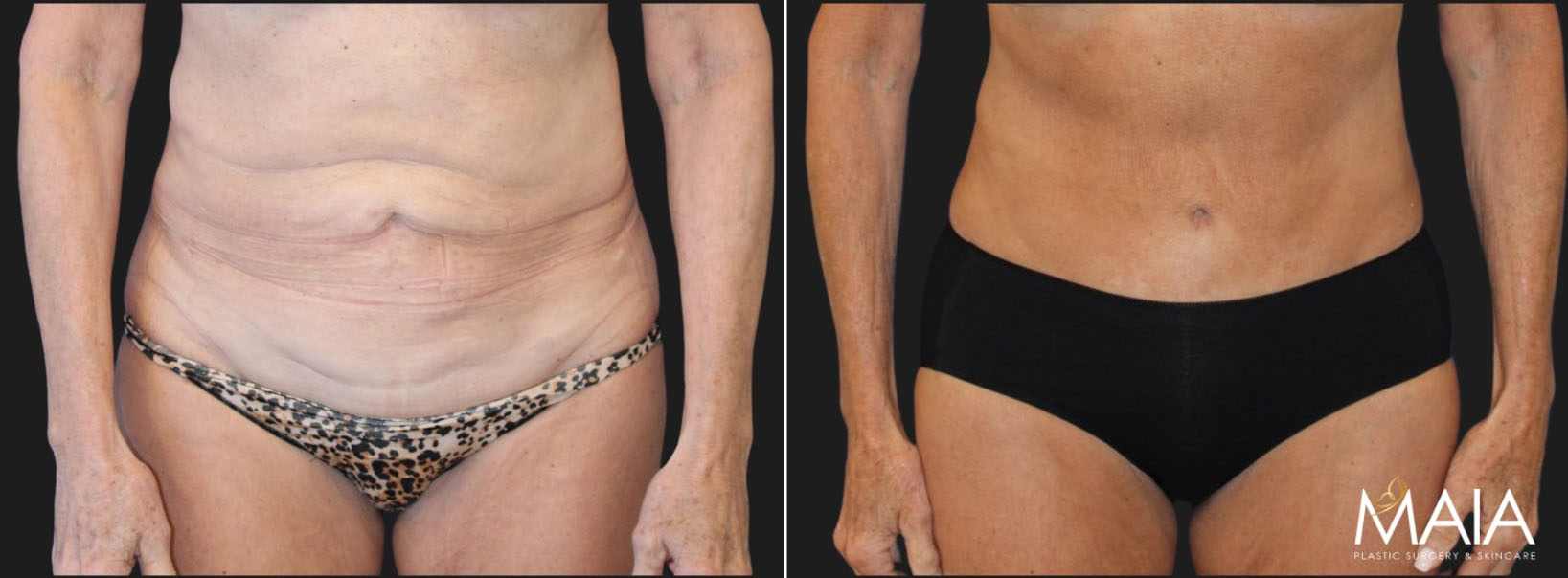 12279_-Mid-60s-patient-before-and-4-months-after-extended-tummy-tuck-liposuction-of-the-upper-back-lower-back-and-flanks - Washingtonian