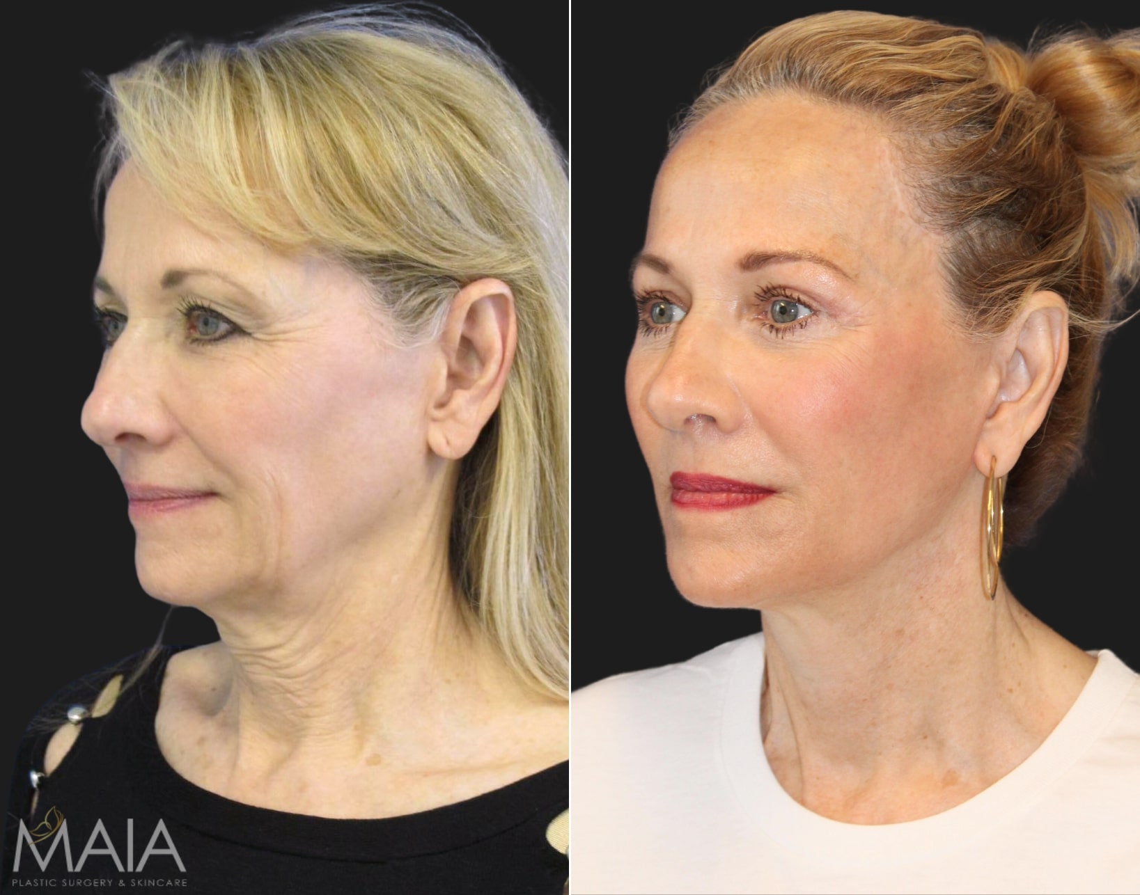 APPROVED-ANGLE-67-year-old-before-and-1-year-after-comprehensive-facial-rejuvenation - Washingtonian